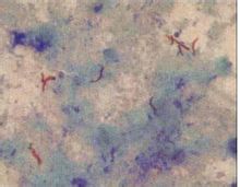 Mycobacterium tuberculosis